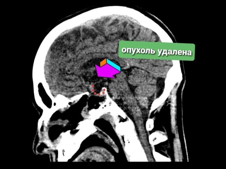 Врачи провели уникальную операцию по удалению опухоли через нос