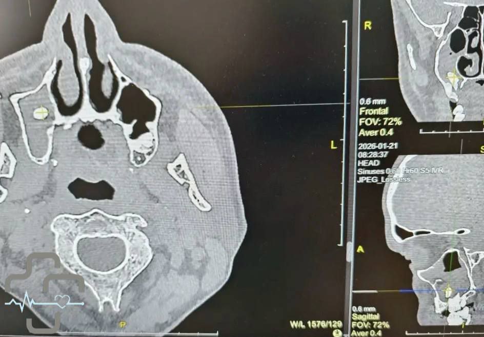 Стоматологи нашли зуб в носовой пазухе пациента