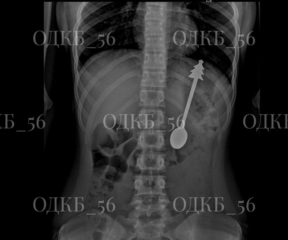 Необычный «полдник»: как в ОДКБ извлекли ложку из желудка ребёнка