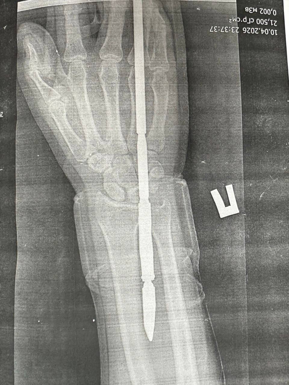 Подводная охота с риском для жизни: орчанин выстрелил себе в руку гарпуном