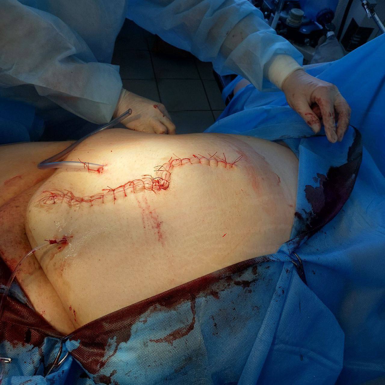 Хирурги спасли пациентку, 15 лет жившую с «бомбой замедленного действия»