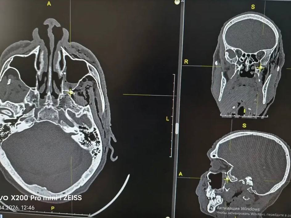 Сосед выстрелил в голову из пневматики: лор-хирург спасла мужчину